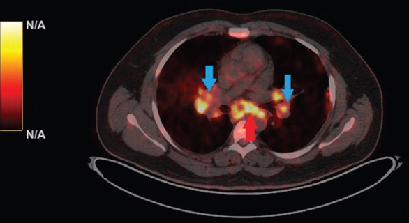 A mediastinal lung window of 18-fluorodeoxyglucose positron emission tomography and computed tomography showing prominent bilateral interlobar (blue arrows) and sub-carinal (red arrow) lymphadenopathy; the florid fluorodeoxyglucose uptake signifies an active disease process.